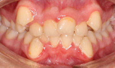 Before Picture – Dunn Orthodontics patient