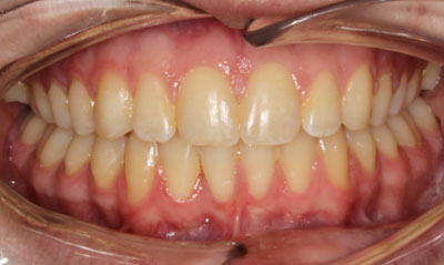 After Picture – Dunn Orthodontics patient