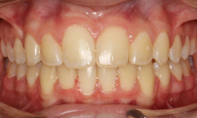 After Picture – Dunn Orthodontics patient