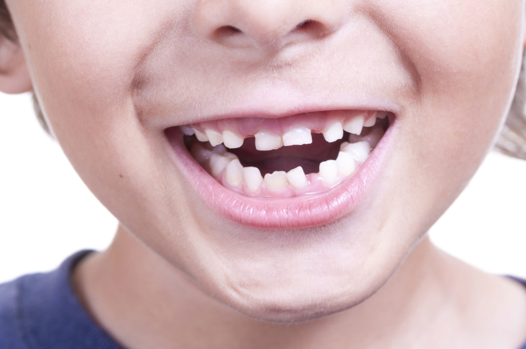 sucking effects orthodontic orthodontics dunn problem adverse