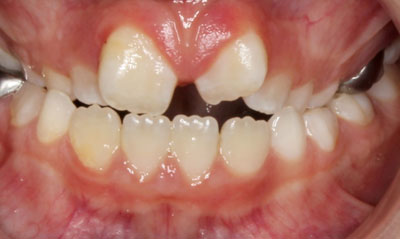 01B Before Picture – Dunn Orthodontics patient
