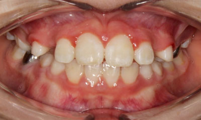01F After Picture – Dunn Orthodontics patient