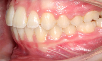 02F After Picture – Dunn Orthodontics patient