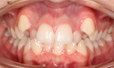03B Before Picture – Dunn Orthodontics patient