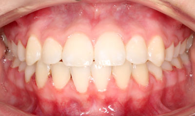 03F After Picture – Dunn Orthodontics patient