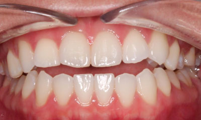 05B Before Picture – Dunn Orthodontics patient