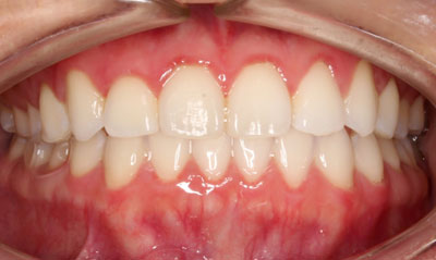 05F After Picture – Dunn Orthodontics patient