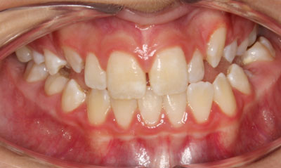 06B Before Picture – Dunn Orthodontics patient