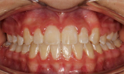 06F After Picture – Dunn Orthodontics patient