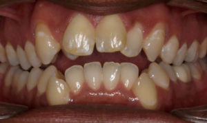 Before Picture – Dunn Orthodontics patient