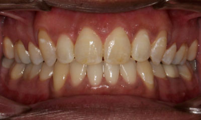 07F After Picture – Dunn Orthodontics patient