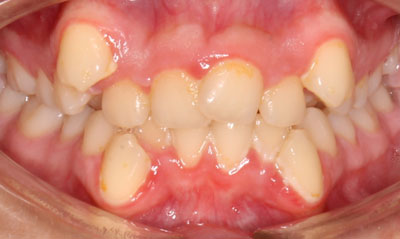 08B Before Picture – Dunn Orthodontics patient