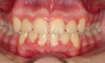 08F After Picture – Dunn Orthodontics patient