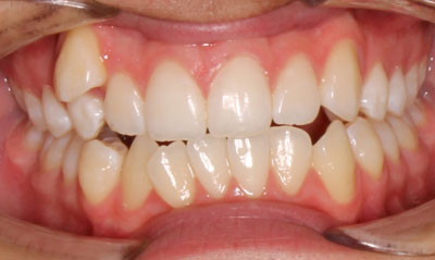 09B Before Picture – Dunn Orthodontics patient