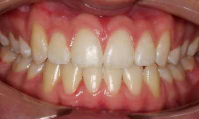 09F After Picture – Dunn Orthodontics patient