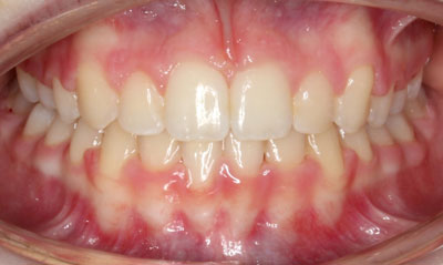 10F After Picture – Dunn Orthodontics patient