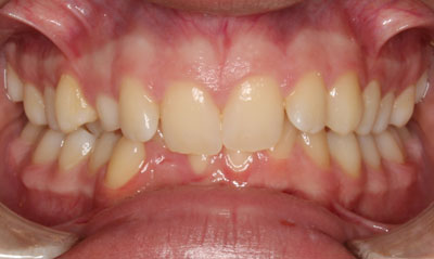 11B Before Picture – Dunn Orthodontics patient