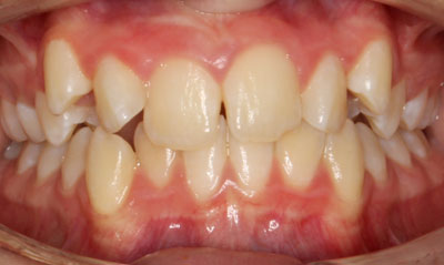 12B Before Picture – Dunn Orthodontics patient