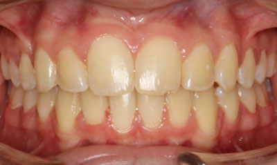 12F After Picture – Dunn Orthodontics patient