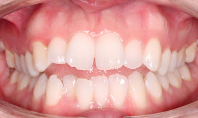 13B Before Picture – Dunn Orthodontics patient