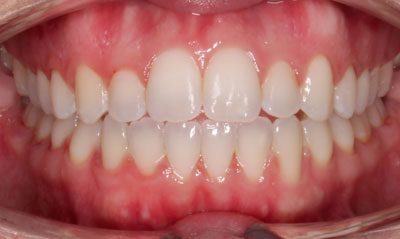 13F After Picture – Dunn Orthodontics patient