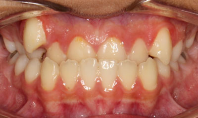 14B Before Picture – Dunn Orthodontics patient