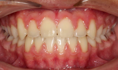 14F After Picture – Dunn Orthodontics patient