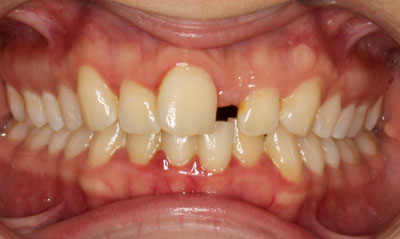 15B Before Picture – Dunn Orthodontics patient