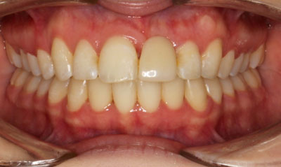 15F After Picture – Dunn Orthodontics patient