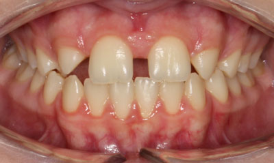 16B Before Picture – Dunn Orthodontics patient