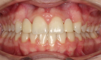 16F After Picture – Dunn Orthodontics patient