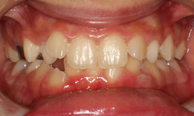 17B Before Picture – Dunn Orthodontics patient