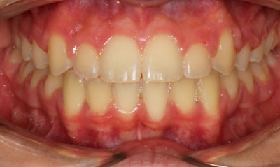 17F After Picture – Dunn Orthodontics patient