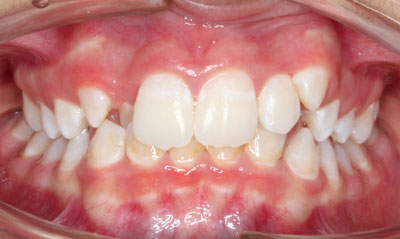 18B Before Picture – Dunn Orthodontics patient