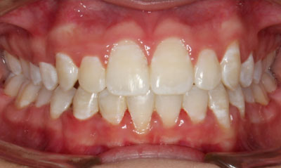 18F After Picture – Dunn Orthodontics patient