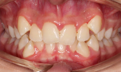 20B Before Picture – Dunn Orthodontics patient
