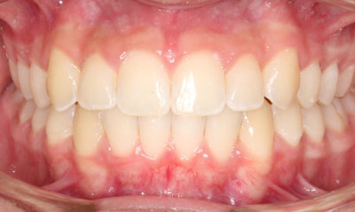 20F After Picture – Dunn Orthodontics patient