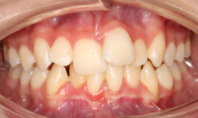 22B Before Picture – Dunn Orthodontics patient