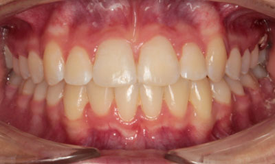 22F After Picture – Dunn Orthodontics patient