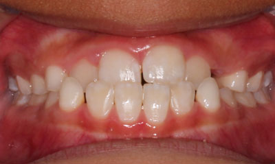 23B Before Picture – Dunn Orthodontics patient