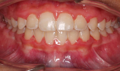 23F After Picture – Dunn Orthodontics patient