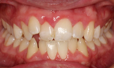 24B Before Picture – Dunn Orthodontics patient