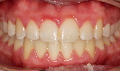 24F After Picture – Dunn Orthodontics patient