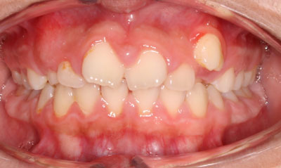 25B Before Picture – Dunn Orthodontics patient