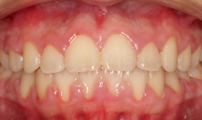 25F After Picture – Dunn Orthodontics patient