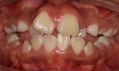 26B Before Picture – Dunn Orthodontics patient