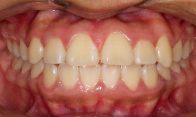 26F After Picture – Dunn Orthodontics patient