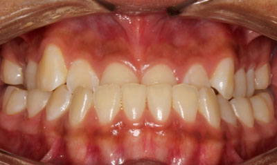 27B Before Picture – Dunn Orthodontics patient
