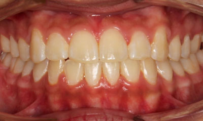 27F After Picture – Dunn Orthodontics patient