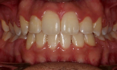 28F After Picture – Dunn Orthodontics patient